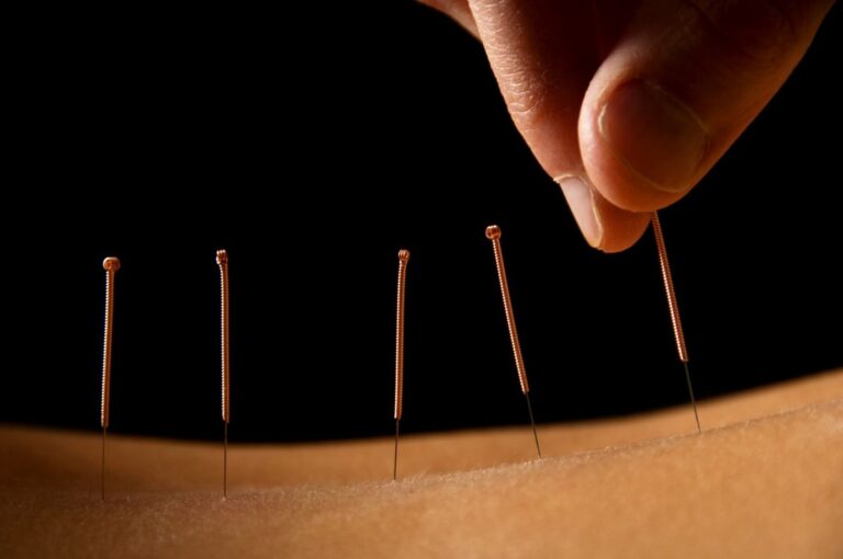 ACUPUNCTURE FOR LOWER BACK