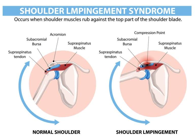 תסמונת הצביטה (Impingement Syndrome)