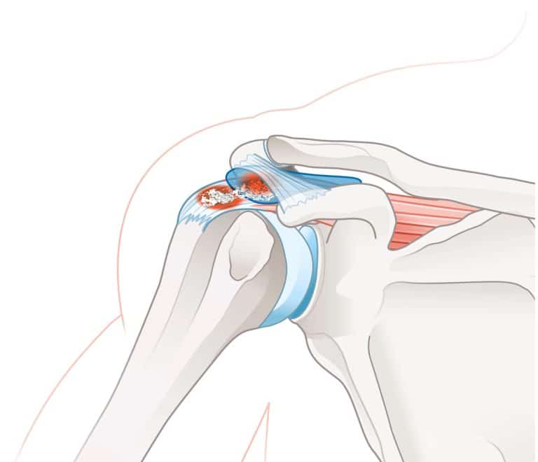 הסתיידות בגיד (Calcific Tendonitis)