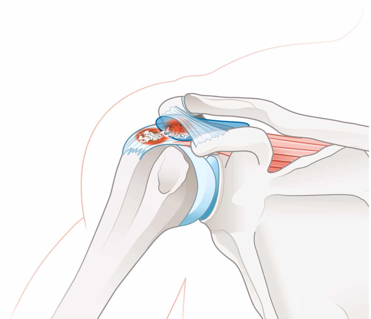 הסתיידות בגיד (Calcific Tendonitis)